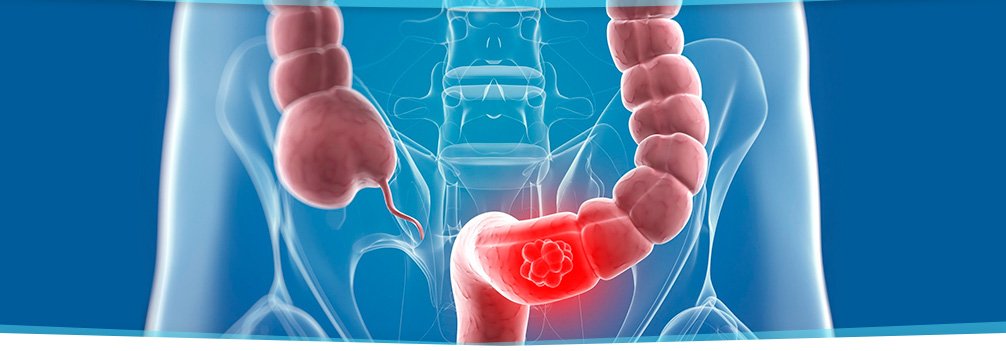 Colon cancer detection in Sebastian